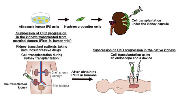 Taking on the challenge of kidney regeneration using iPS cells with ...